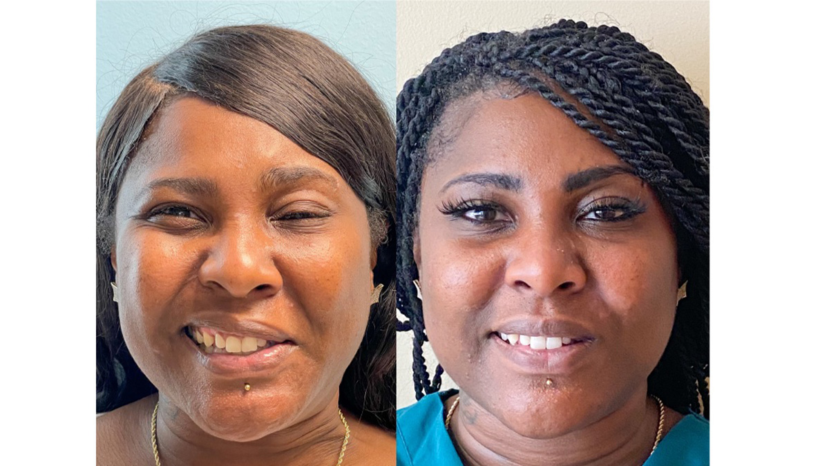 A Black woman with chronic Bells palsy before (left) and after treatment (right).